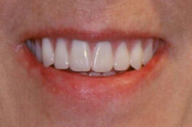 Teeth-4-After