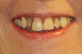 Teeth-4-Before